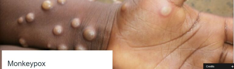 Mpox Again! WHO Declares Health Emergency